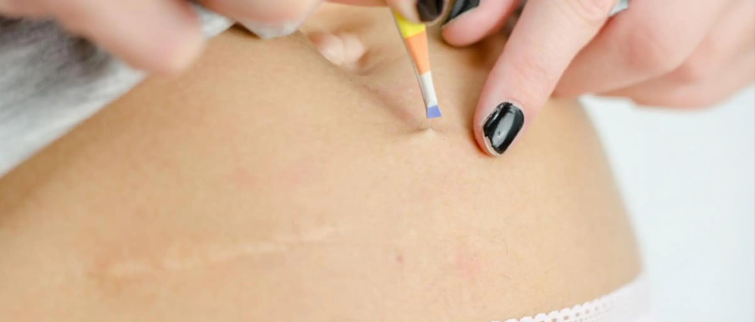 PreventionIngrownHair