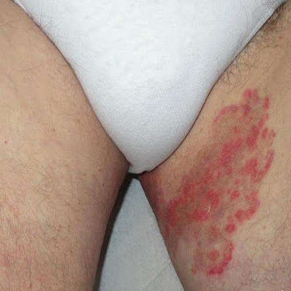 TransmittedMycoplasma